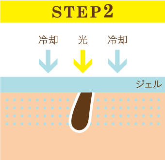 ジェルを塗り光をあてます。周辺の皮膚を冷却しながら体毛だけに熱をあてます。